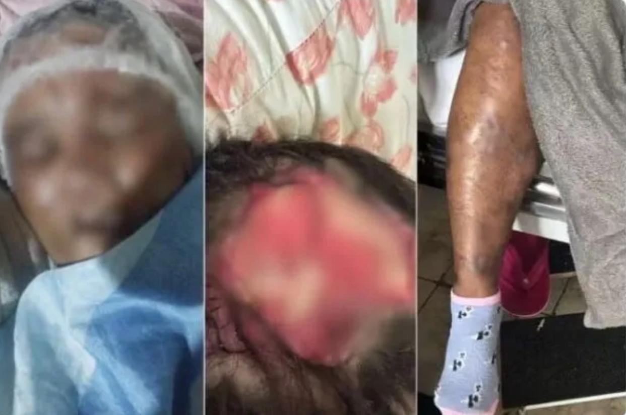Homem que queimou e tirou couro cabeludo da mulher no Guarujá é preso em Araçatuba